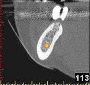 3D-Implantatplanung - Detailaufnahme 3