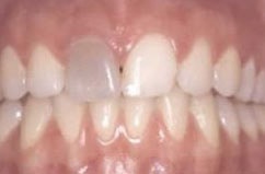 Einzelner dunkler Zahn nach Wurzelbehandlung