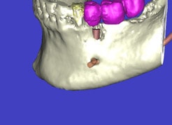 Schematische Darstellung des Unterkiefers mit Implantaten